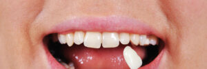 shade determination tooth with help of a shade guide to help patient replace missing tooth
