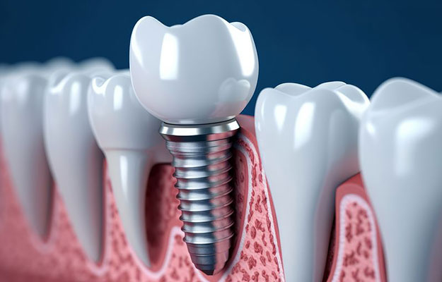 dental implants ashburn va