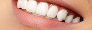 Beautiful smile with porcelain veneer teeth