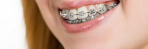 Young girl smiling with braces on her teeth