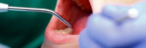 A dentist is checking a patient's mouth before doing a root canal