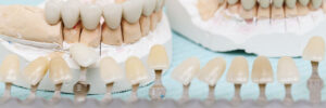 Porcelain covers for dental crowns