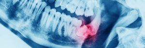 X-ray oral image with an inflamed wisdom tooth