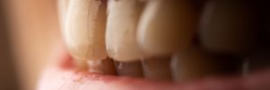 Man smiling with tooth enamel issues
